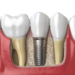 Anatomy of healthy teeth and tooth dental implant in human dentu